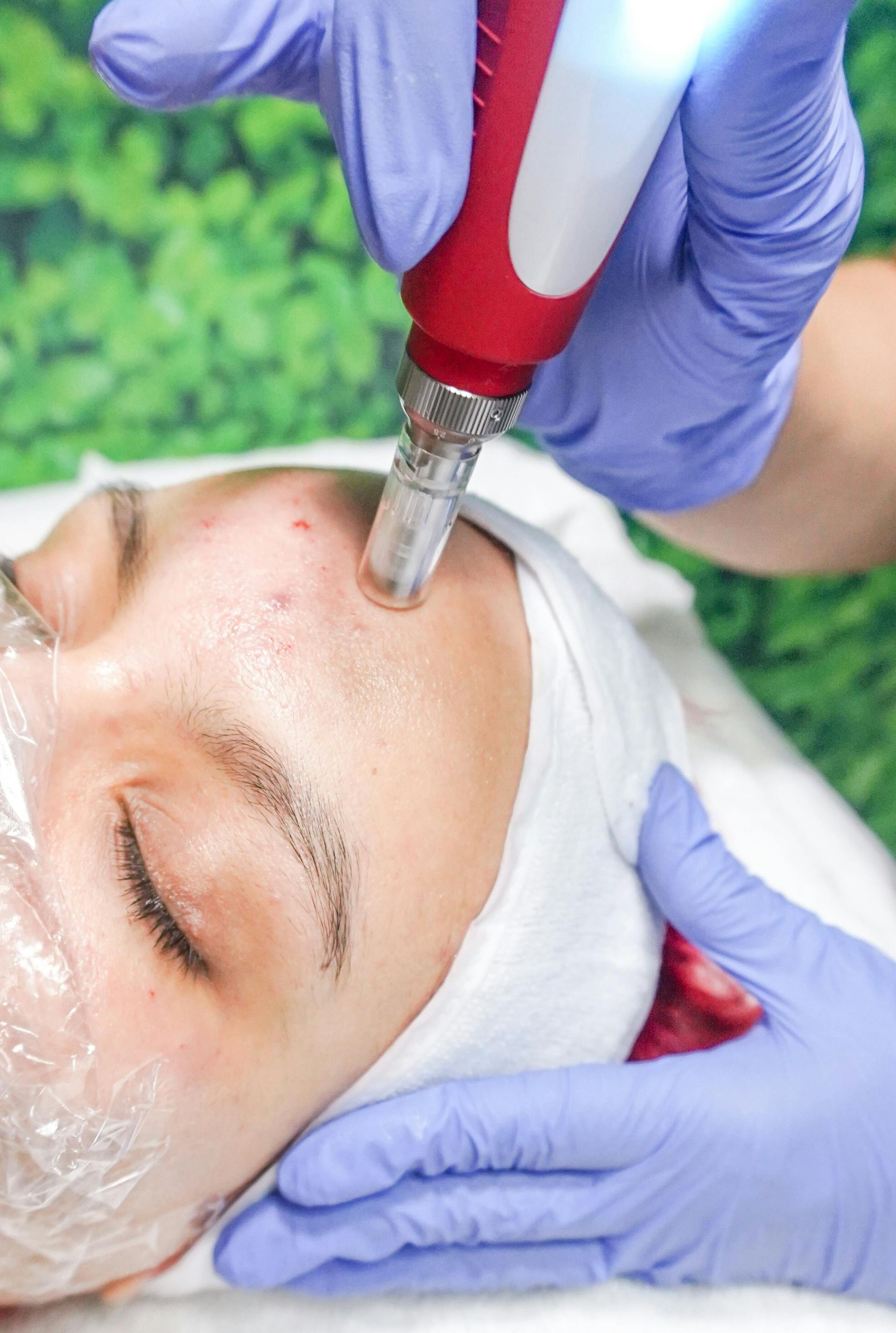 A professional in blue gloves performs microneedling on a person’s forehead with a red-and-silver cosmetic device.