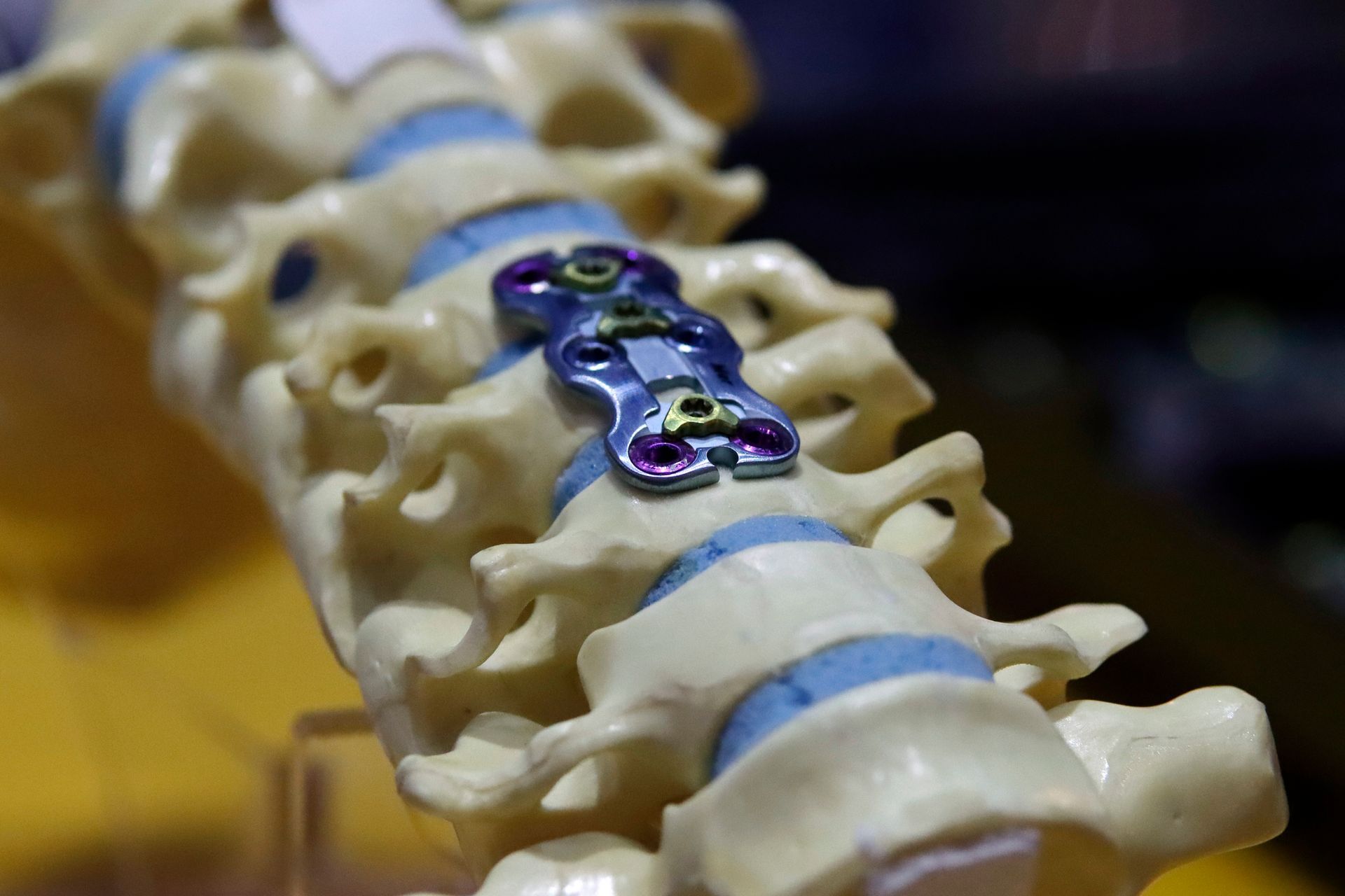 A spine implant. A spine implant.