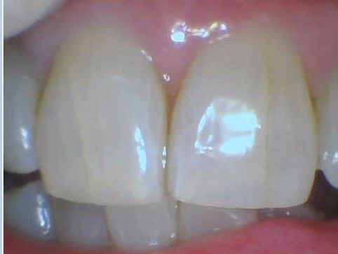 Close-up of two front teeth with a small gap and glossy reflection on the enamel