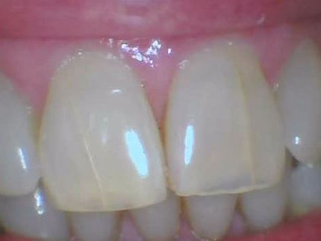 Close-up of two front teeth with a small gap and pink gums above