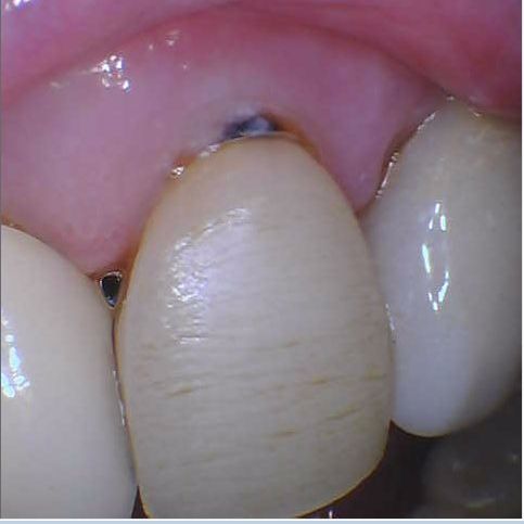 Close-up of front teeth with a gum recession and a small exposed metal dental post.