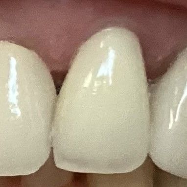 Close-up of three white front teeth against pink gums