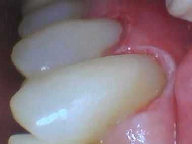 Close-up of two teeth and pink gums inside a mouth