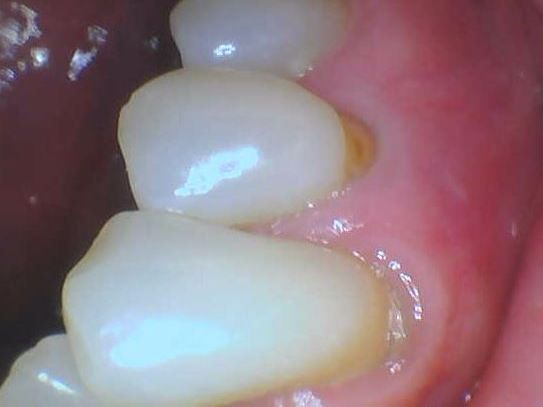 Close-up of two white teeth beside a red gum with a small yellow-brown stain near the gumline
