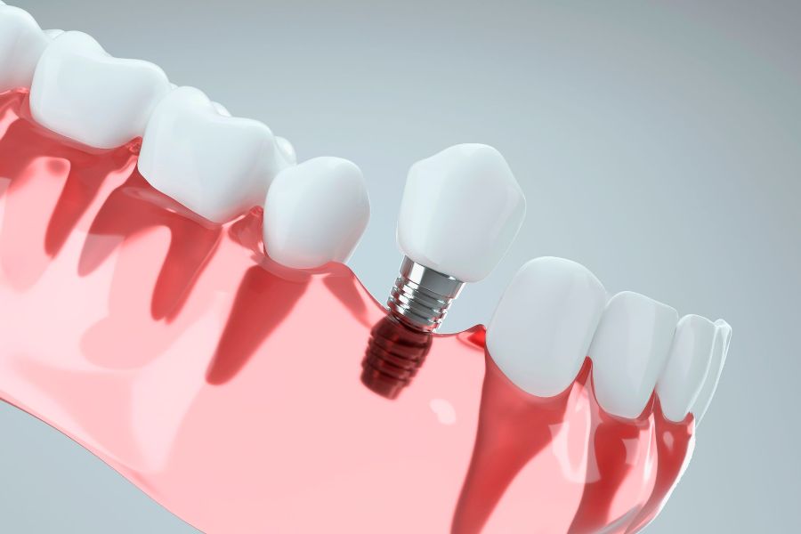 Close-up of dental implant with white crowns on pink gums