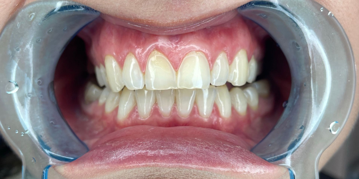 Teeth shown with a cheek retractor and mirror during a dental exam