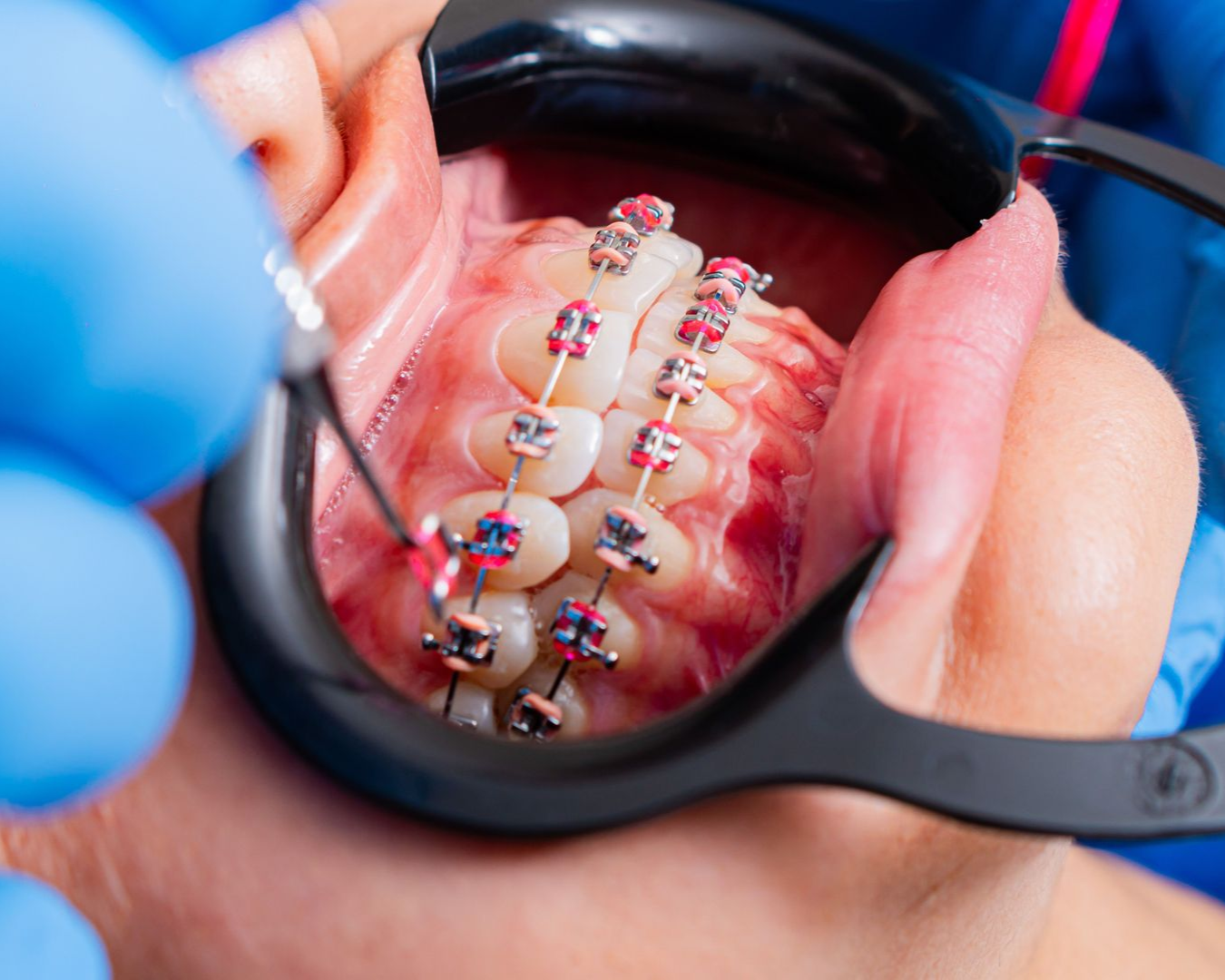 Dental braces being adjusted with a magnifying tool and gloved hands