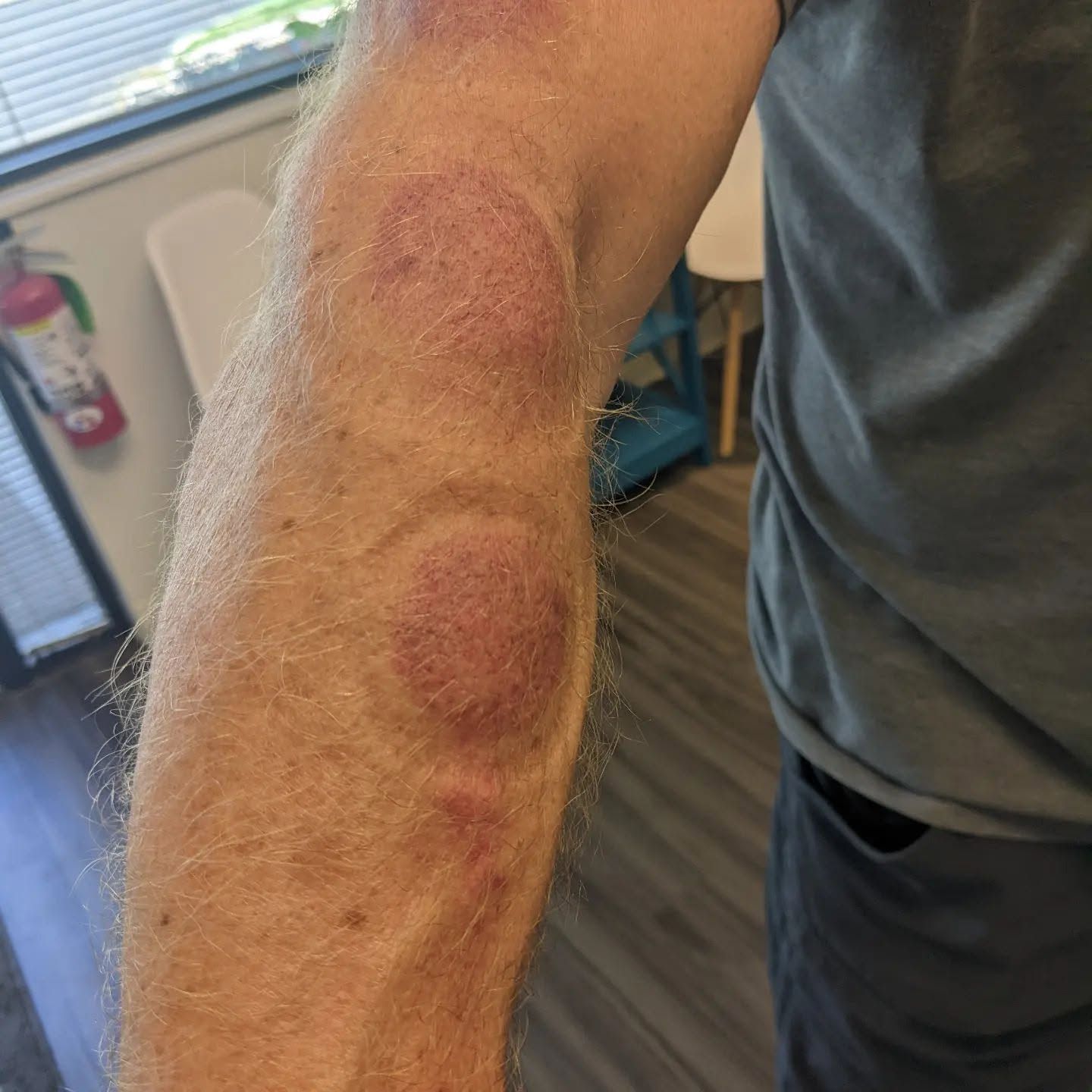 Close-up of a person’s forearm with several red, circular skin patches indoors