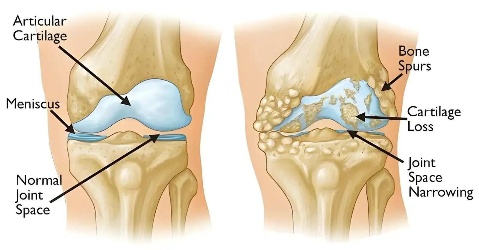 Comparison of a Healthy Knee Joint with an Arthritic Knee Joint