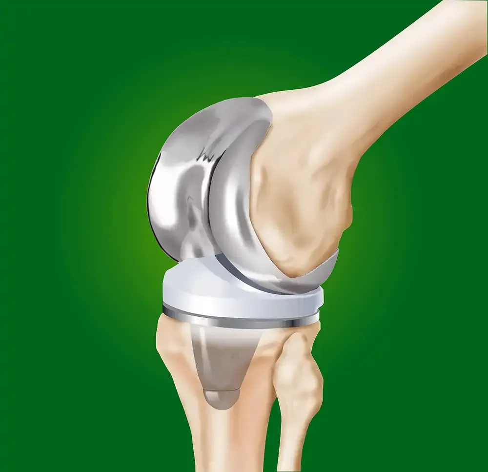 Replacement Knee Joint