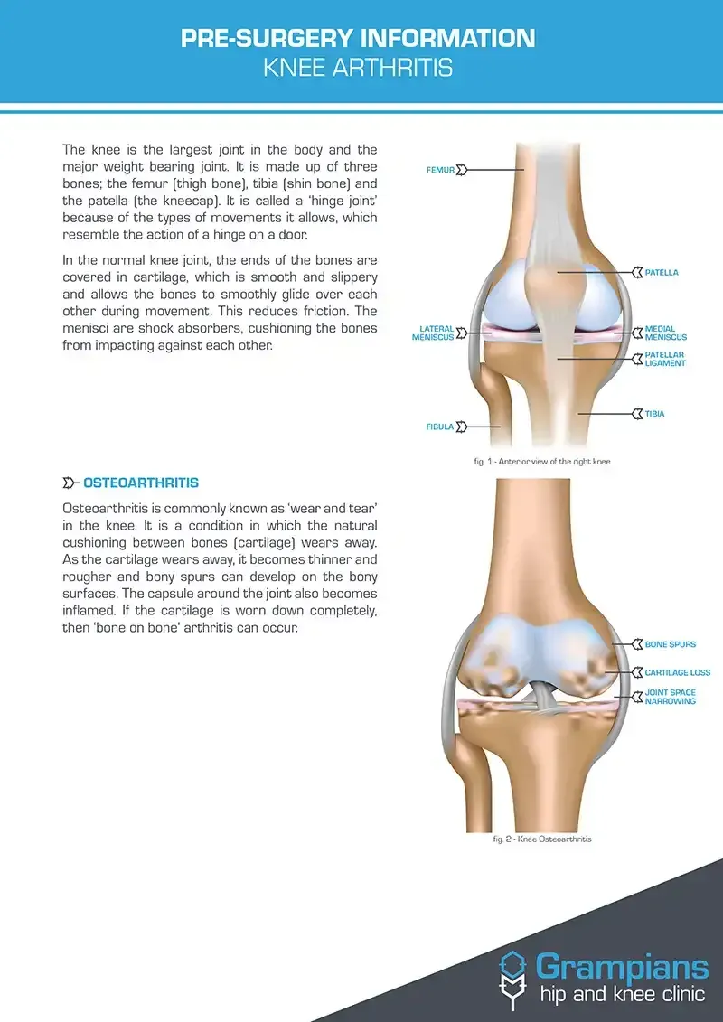 Pre Knee Replacement Surgery Information