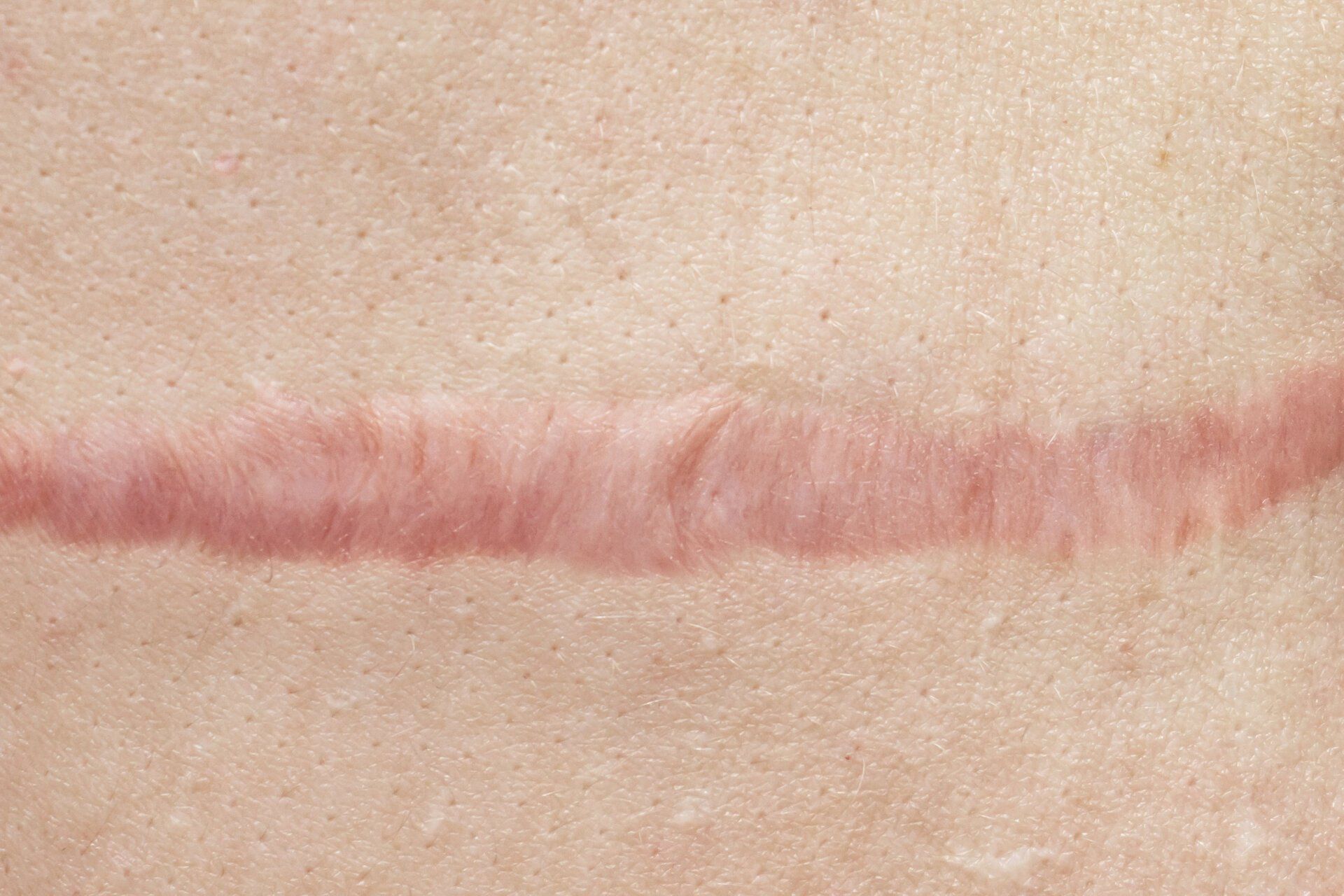 Post Surgical Scar Repair