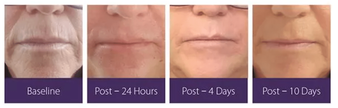 Before and After's of the Opus Glow Plasma Skin Resurfacing