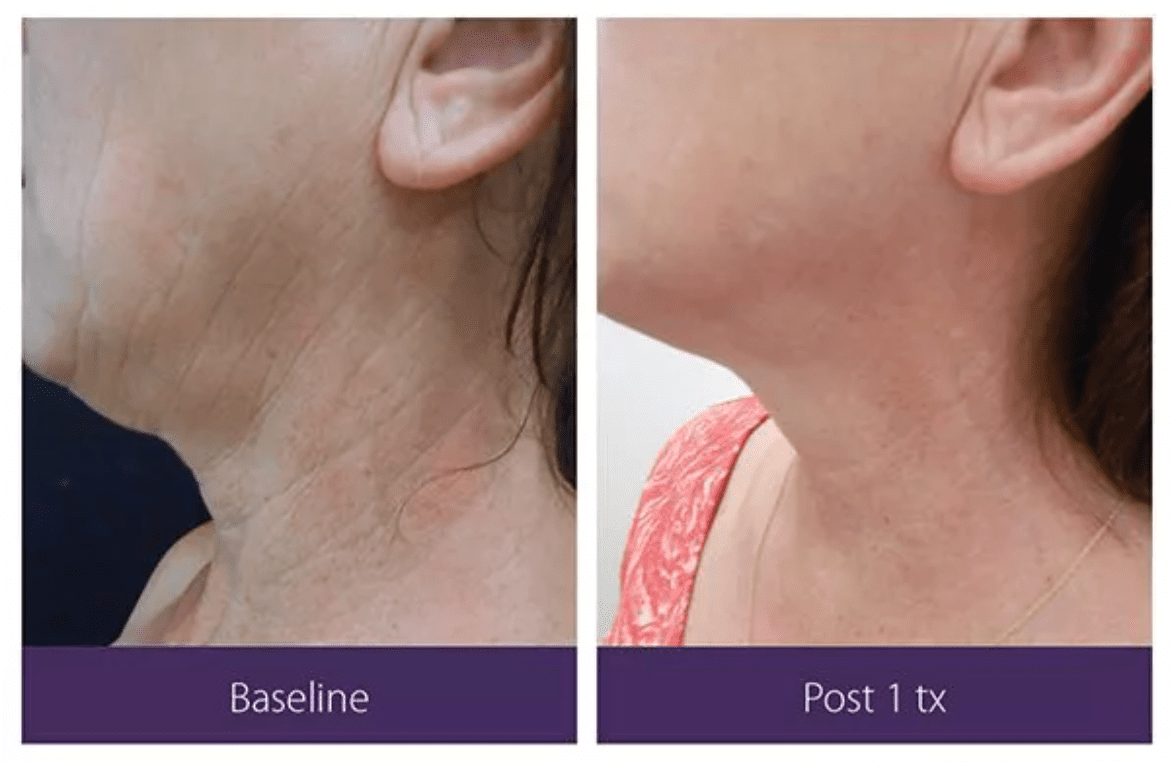 Before and After's of the Opus Glow Plasma Skin Resurfacing