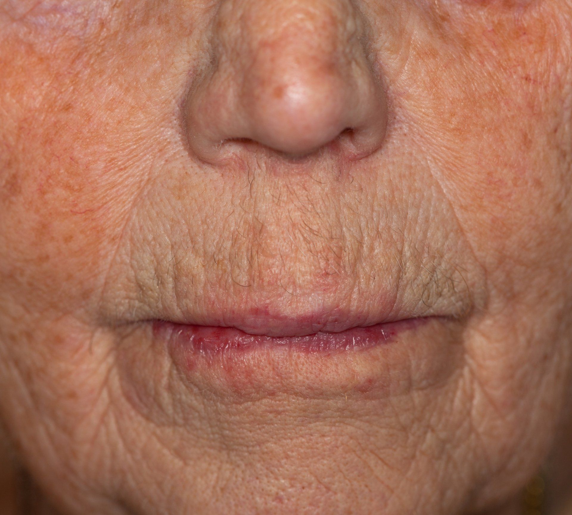 Wrinkle Reduction