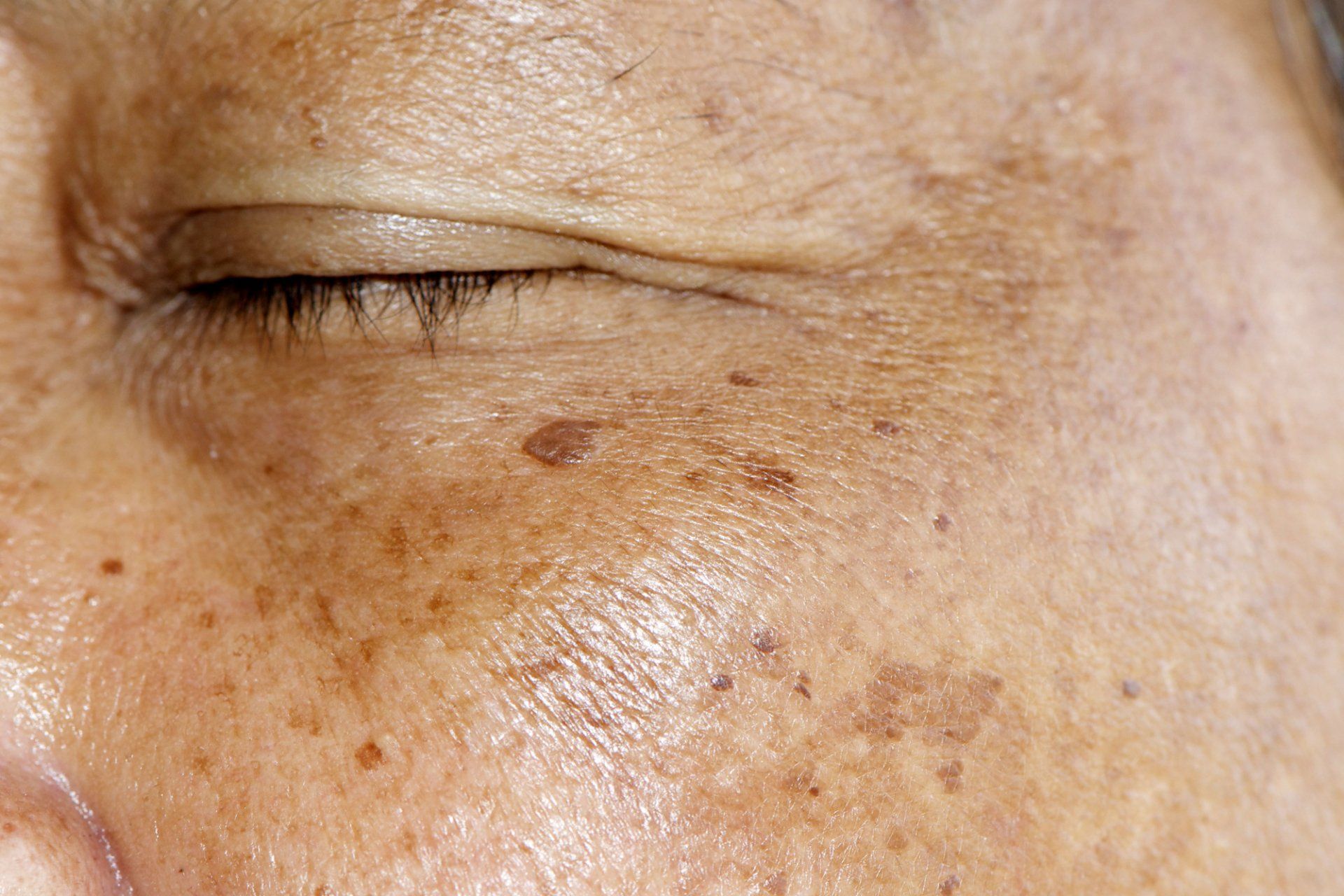 Sun Damage Restoration