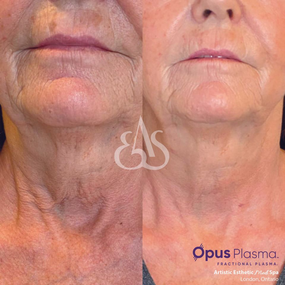 A before and after photo of a woman 's face and neck