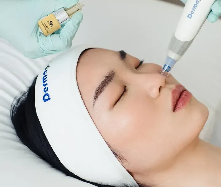 Skin resurfacing being done in London