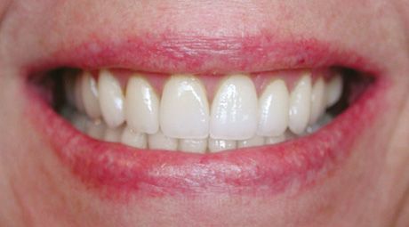 No Cavity — Topeka, KS — Today’s Dentistry