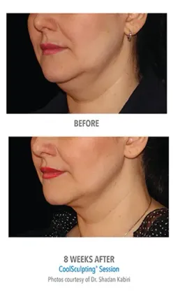 Before Cool Sculpting treatment