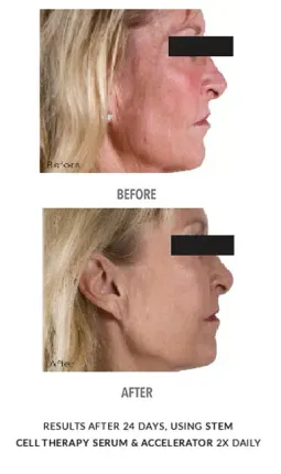 after Cool Sculpting treatment