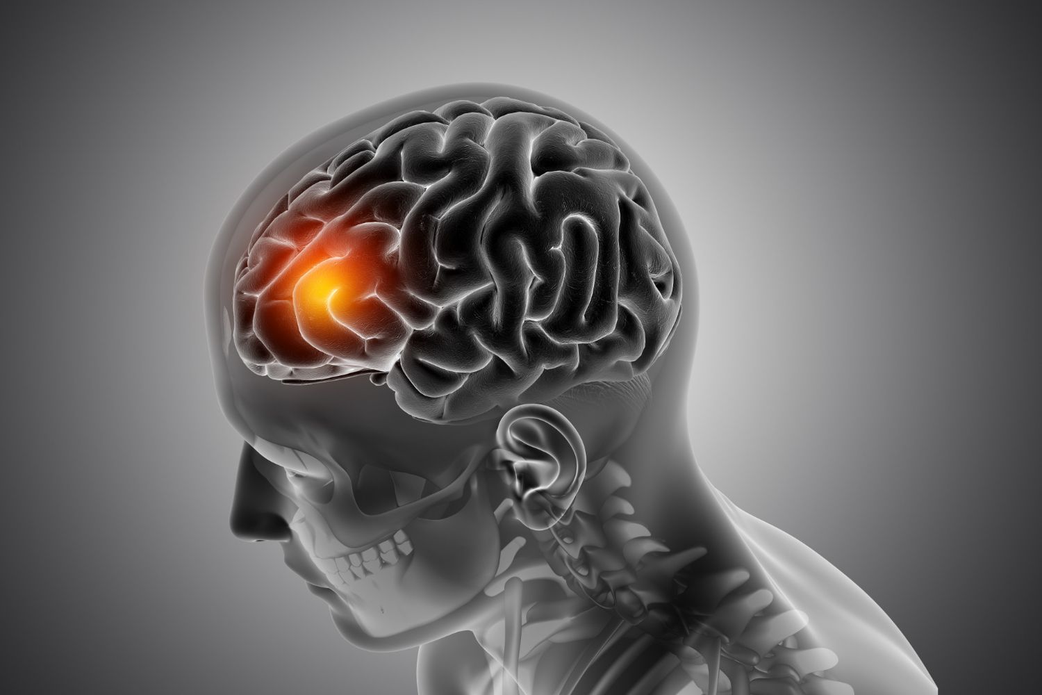Derrame Cerebral