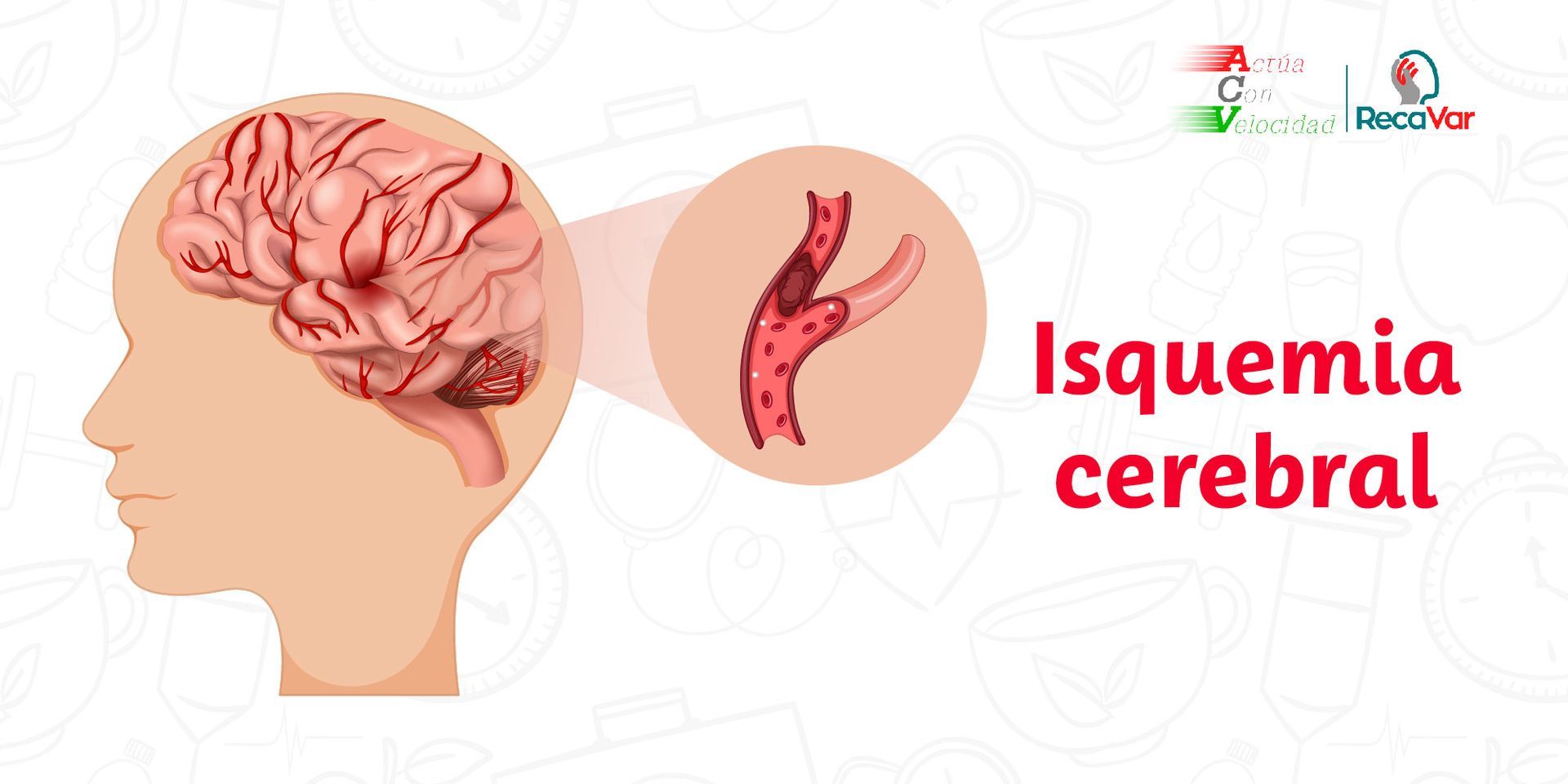 isquemia cerebral