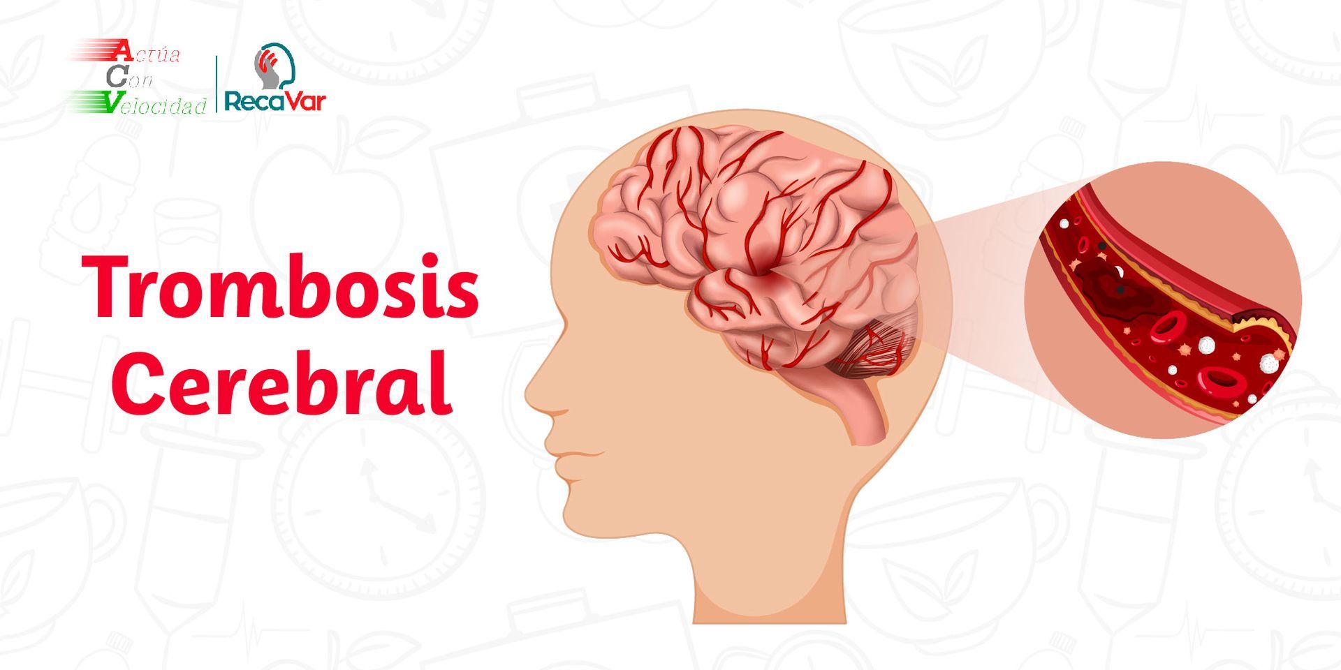Trombosis cerebral Trombosis cerebral