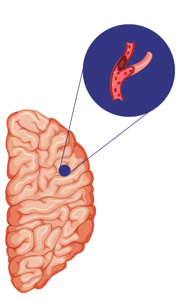 ACV isquémico