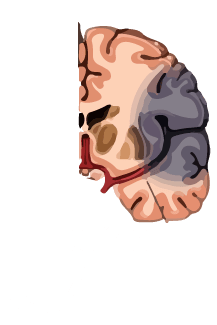 Ataque Cerebrovascular Isquémico