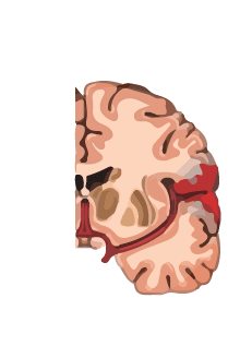 Ataque Cerebrovascular Hemorrágico