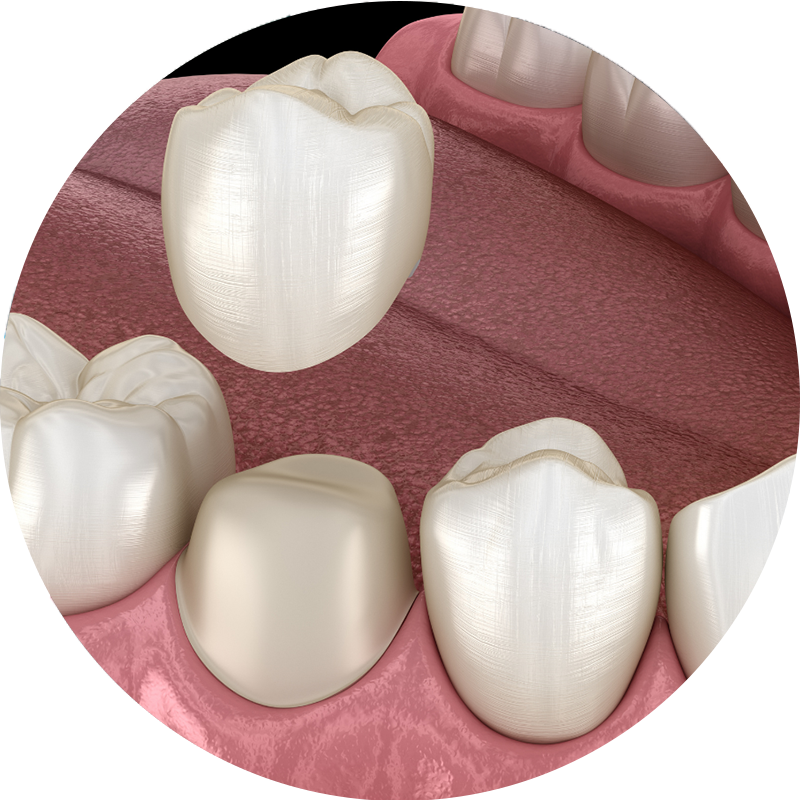 A close up of a person's teeth with dental crowns on them.