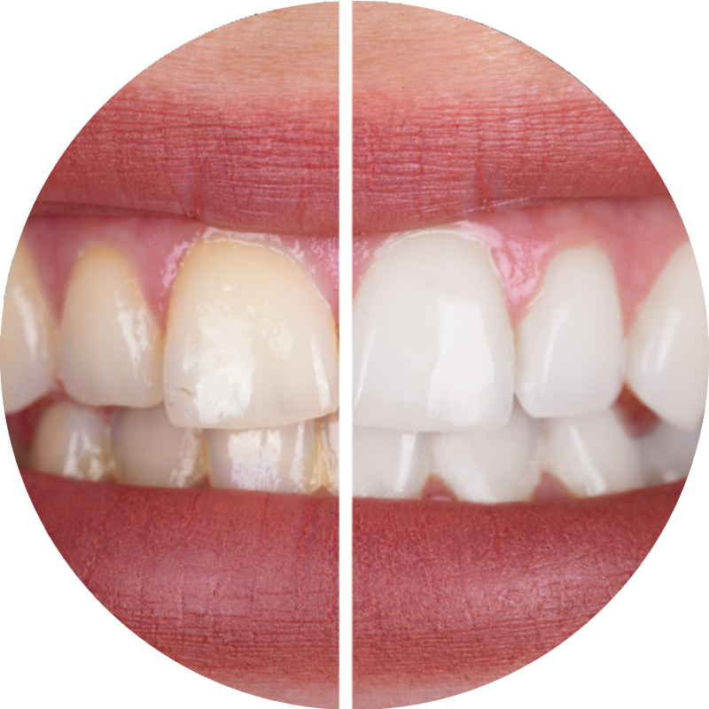 A before and after picture of a person's teeth