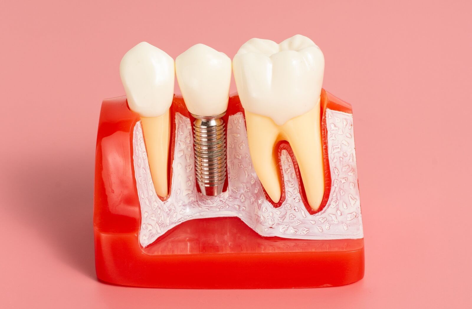 A cross-section dental model showing a metal screw implant anchored in the jawbone between two natural teeth, illustrating the structure of a permanent dental implant.