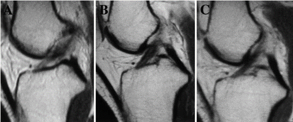 Ruptured ACL on MRI