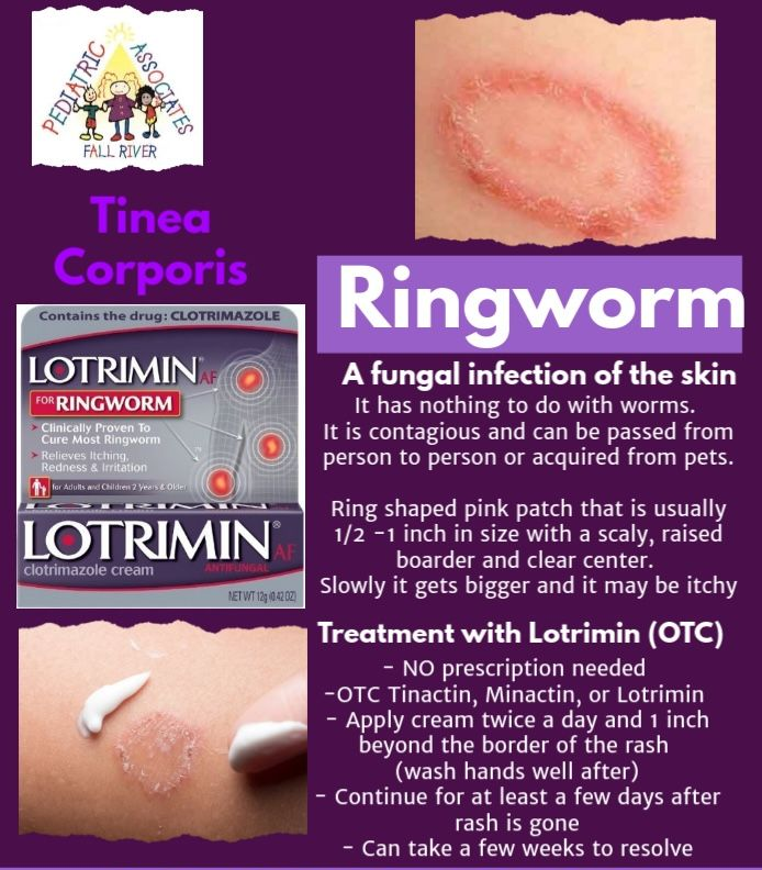 Tinea corporis infographic with ringworm rash photos and Lotrimin treatment instructions