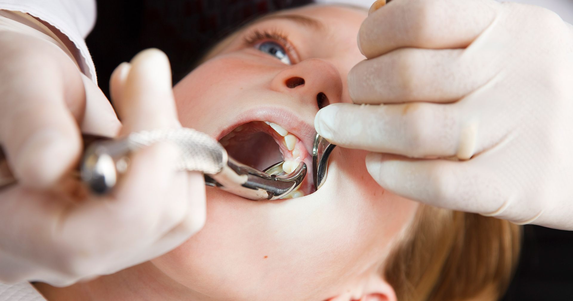 A dentist wearing gloves performs a tooth extraction on a patient using metal dental forceps.