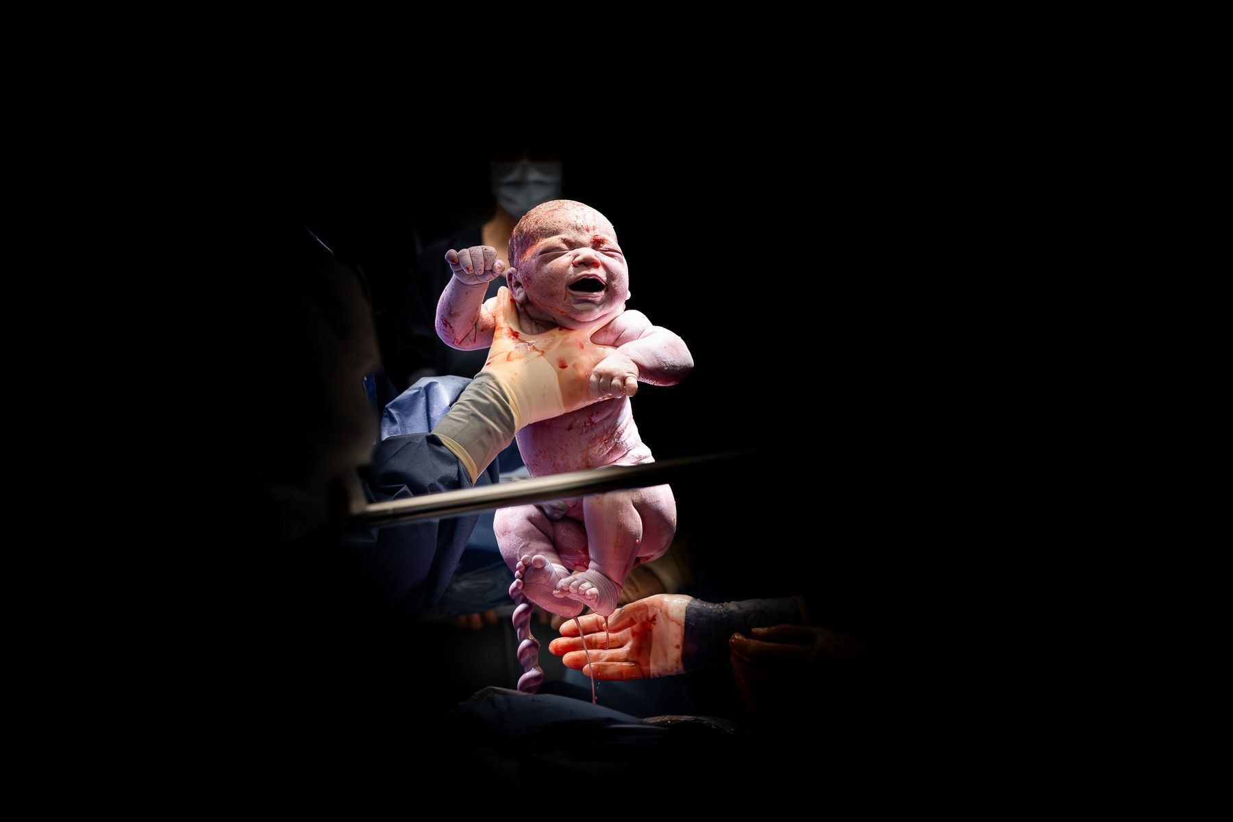 Baby wordt geboren tijdens een keizersnede in de operatiekamer