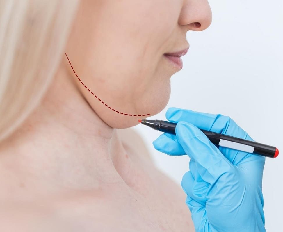 Kybella Treatment near me