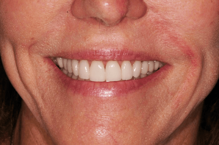 A close up of a woman 's smile with white teeth.