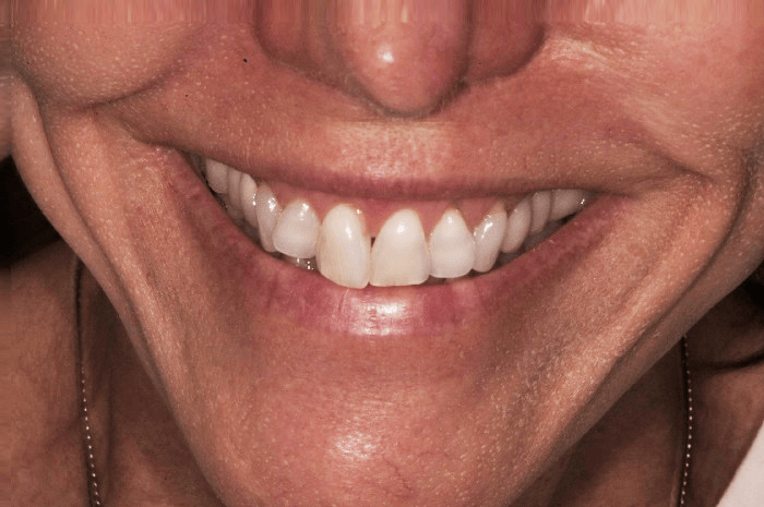 A close up of a woman 's smile with white teeth.