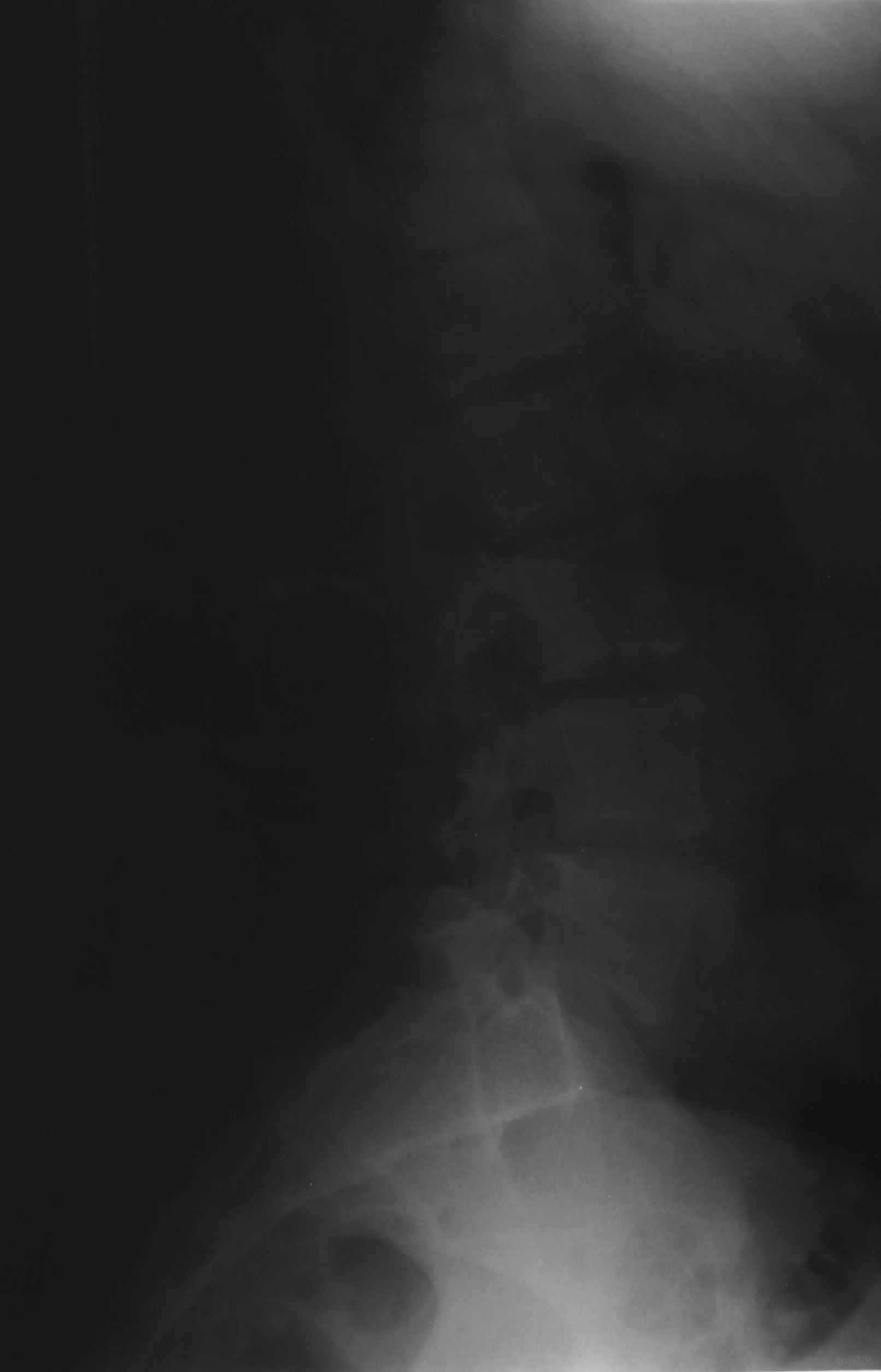 radiografia evidenzia mieloma