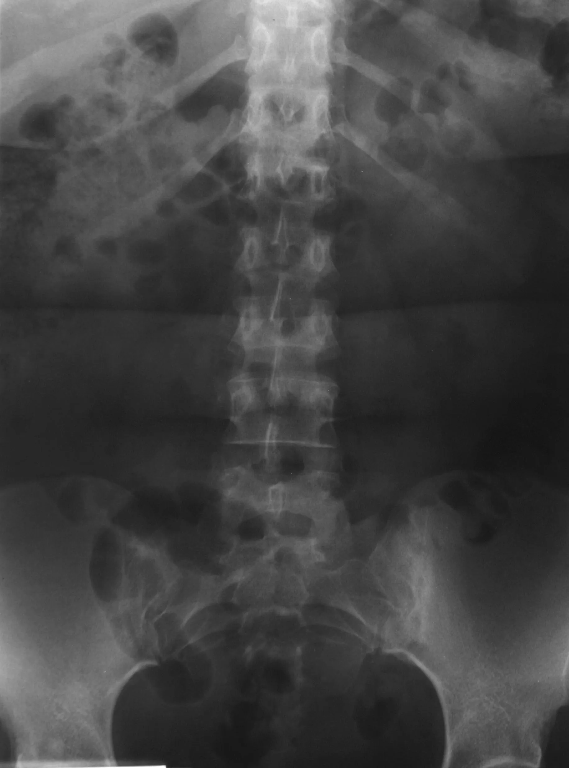 radiografia colonna vertebrale