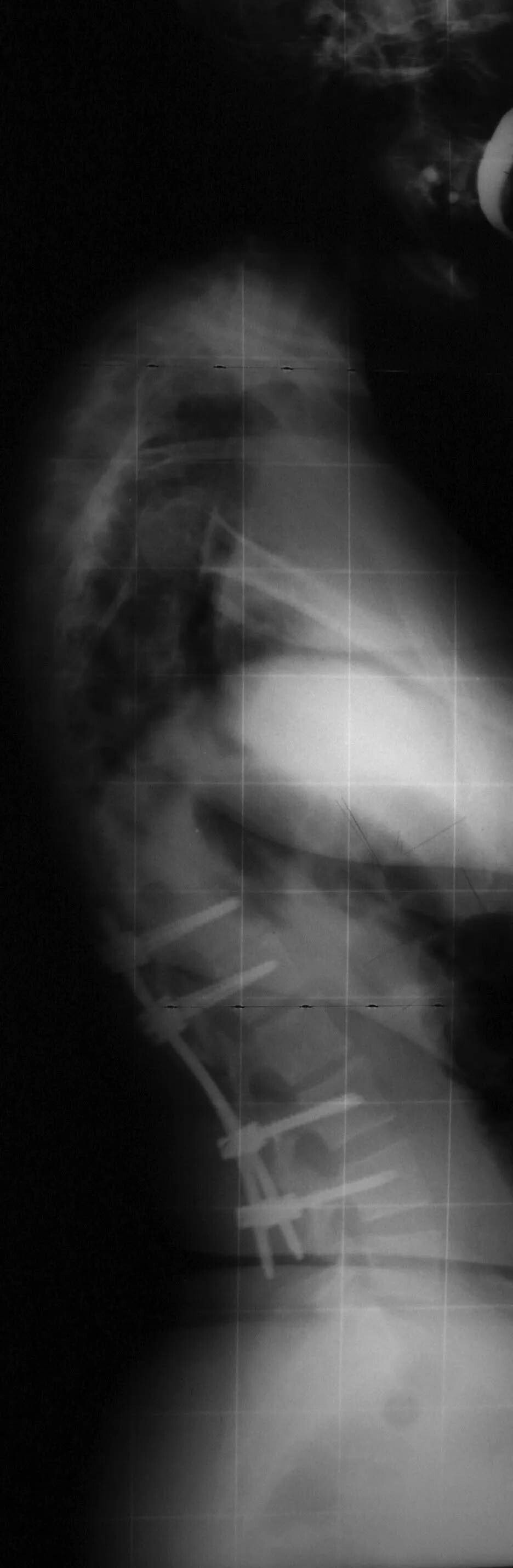 mieloma vertebrale