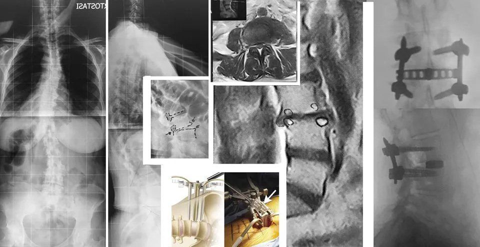 radiografie della spina dorsale