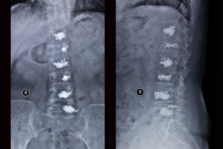 radiografia evidenzia instabilità vertebrale