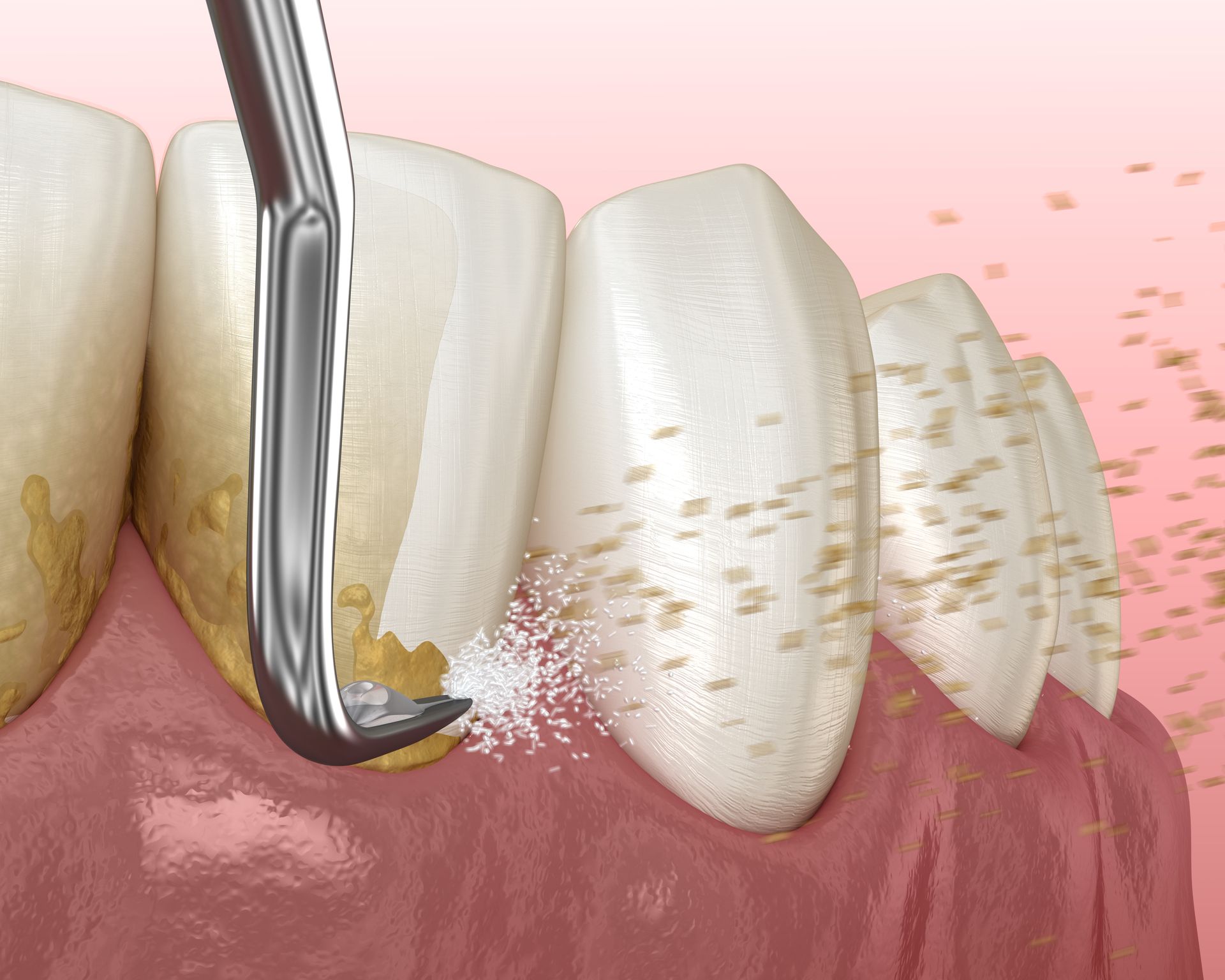 Teeth being cleaned with a dental tool, removing plaque. Pink gums, white teeth, close-up view.