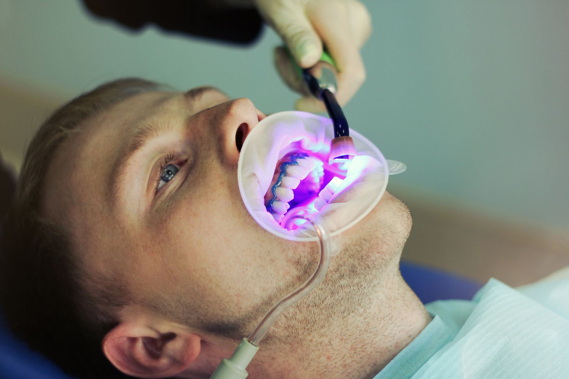 Man at dentist with mouth open; ultraviolet light used on teeth.