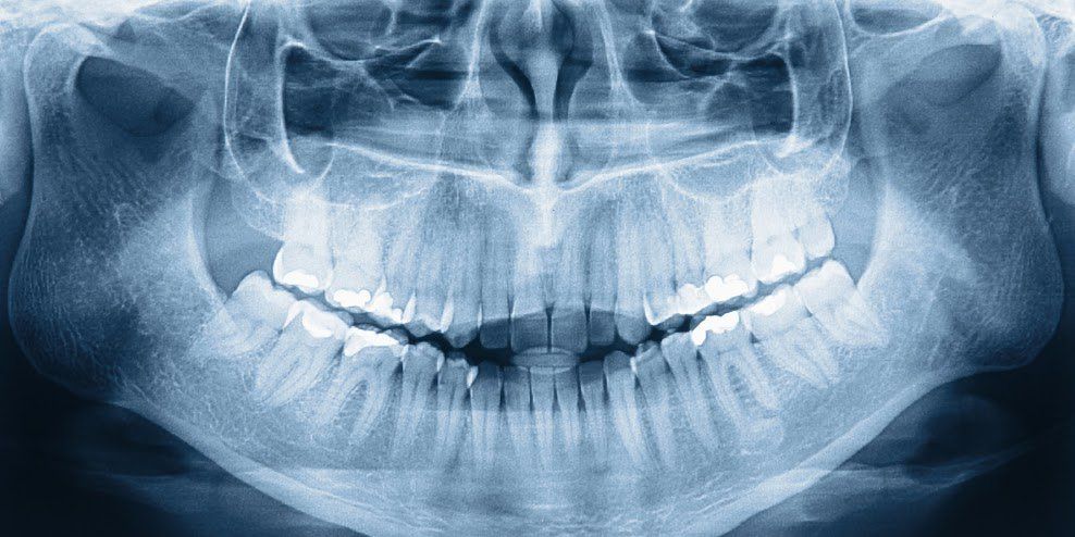 Dental panoramic X-ray showing the teeth and jaw bones in shades of white and gray, against a blue background.