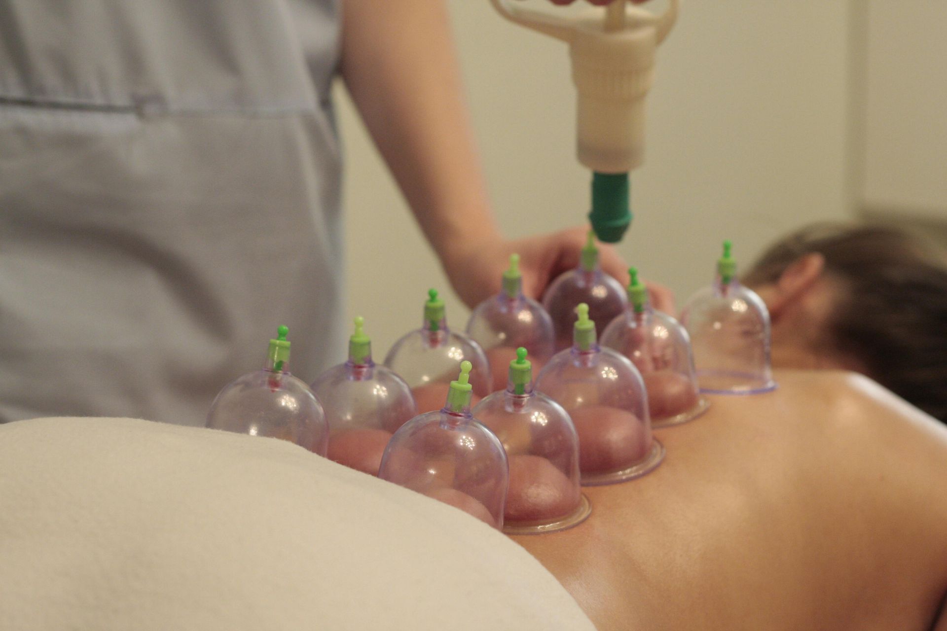 A woman is getting a cupping treatment on her back Ohio.